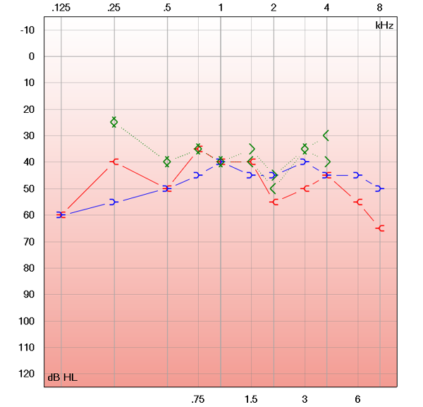 Bilan Auditif Gratuit à Le Lamentin